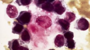 _85730102_c0151822-metastatic_breast_cancer,_micrograph-spl